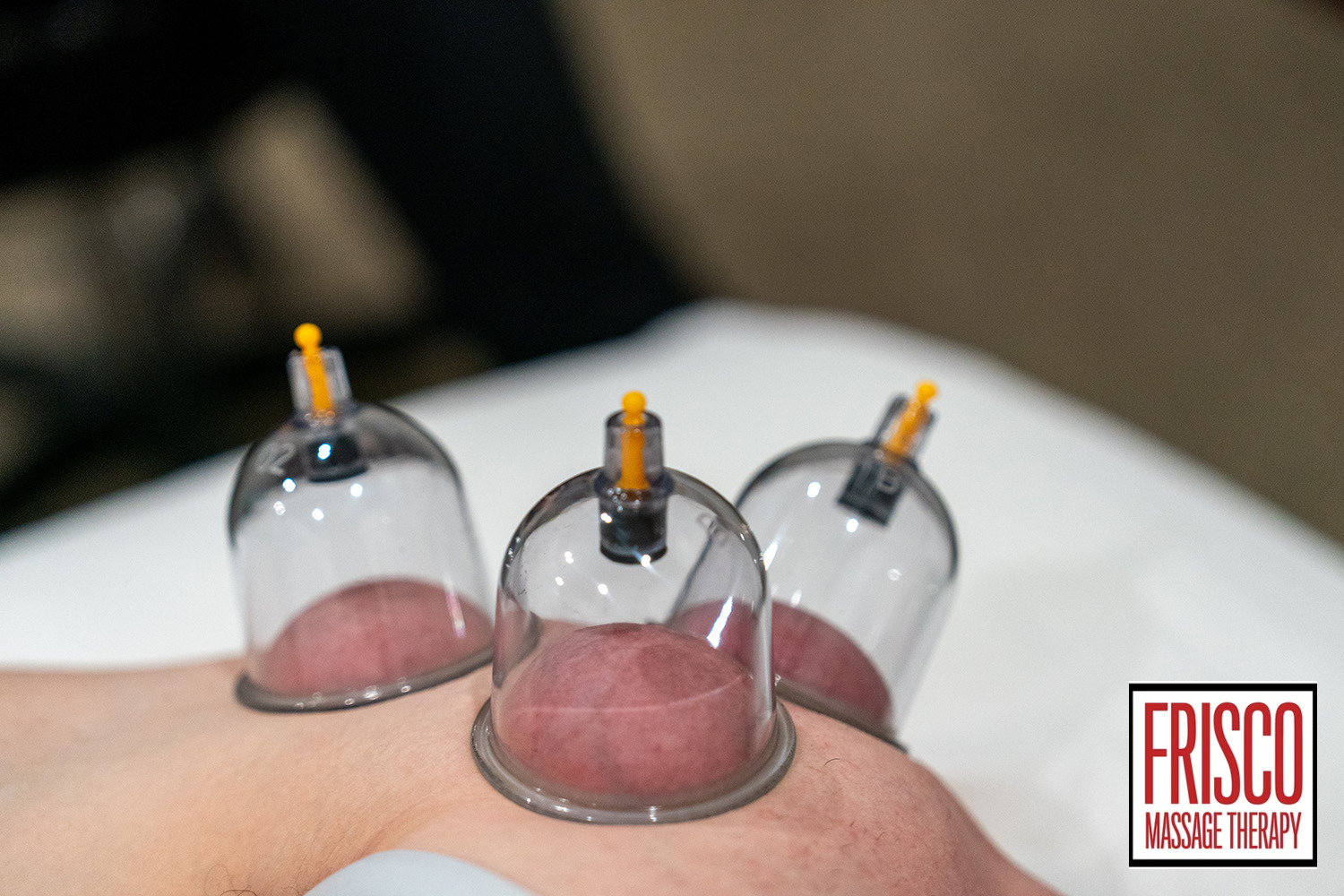 Three glass skin cupping therapy cups placed on a person's back, with the Frisco Massage Therapy logo in the bottom right corner.